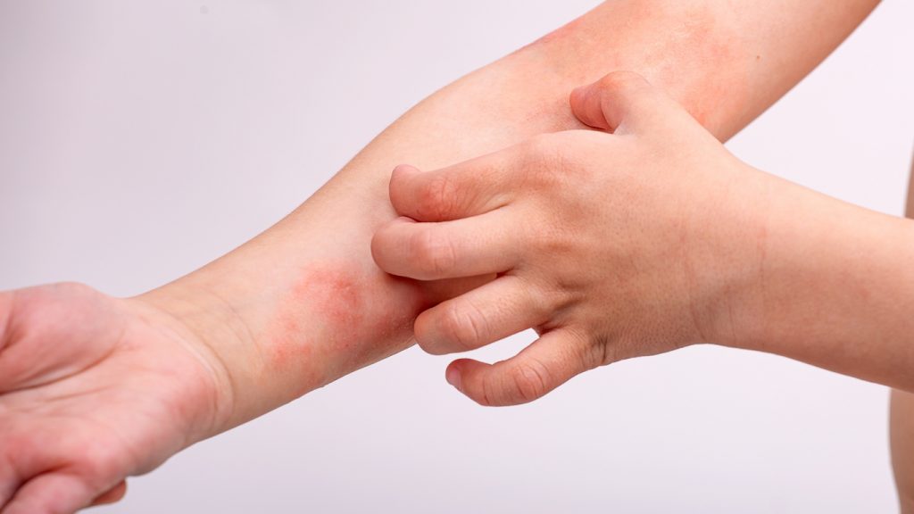 Dermatitis Atópica (Eczema) en Niños