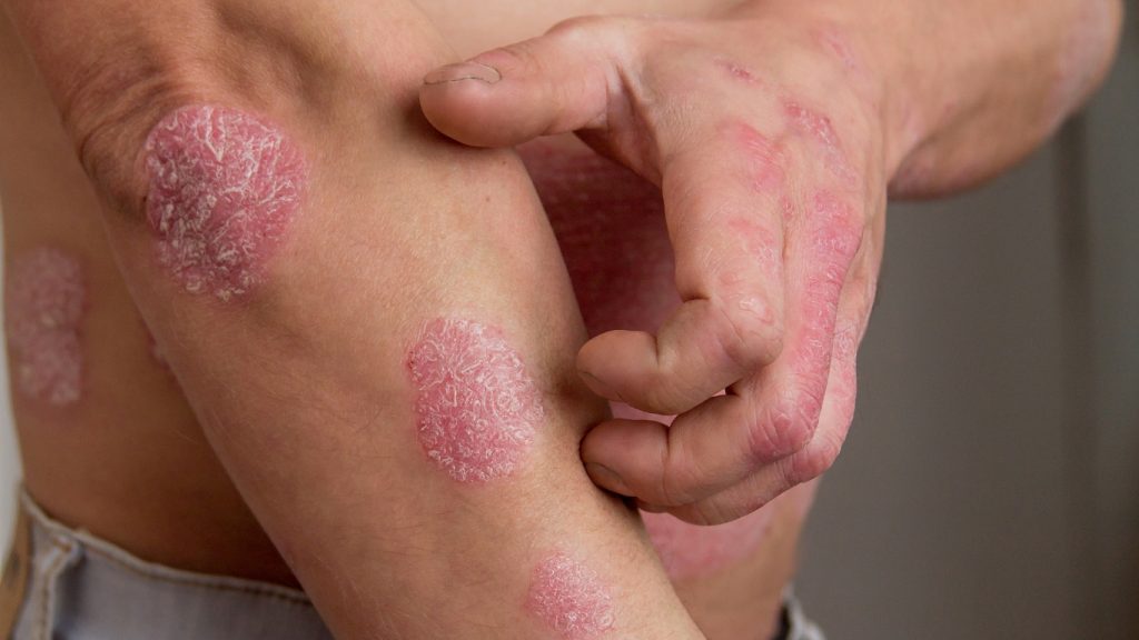Cuando la Piel Habla: Todo sobre la Psoriasis