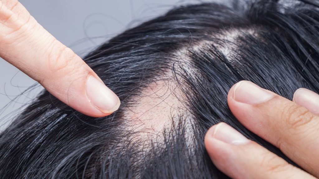 Alopecia: ¿Por qué ocurre y cómo tratarla?