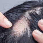 Alopecia: ¿Por qué ocurre y cómo tratarla?