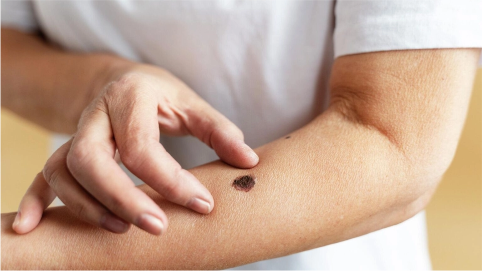 Cáncer de piel melanoma y no melanoma