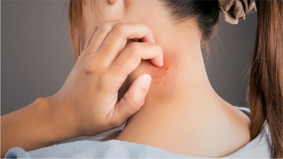 Dermatitis seborreica