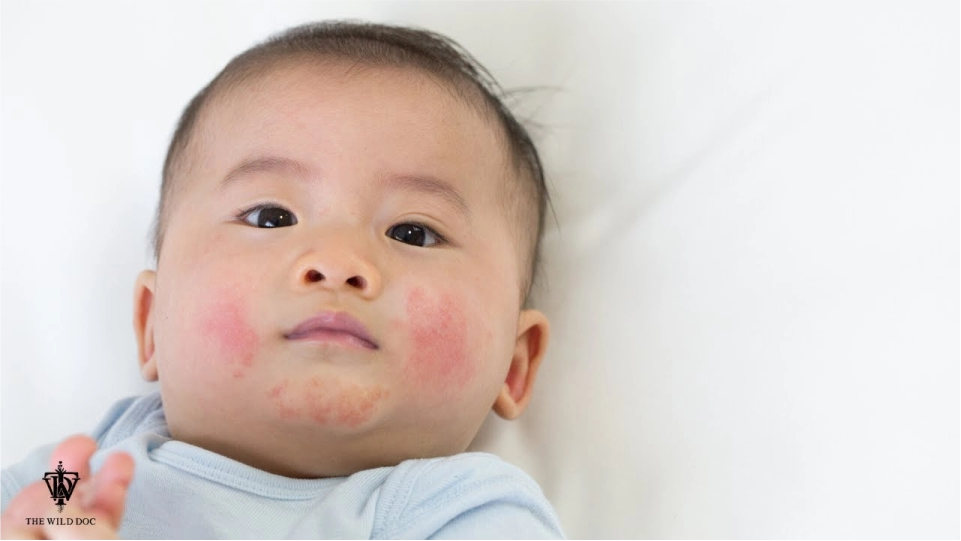 Eczema dermatitis atópica
