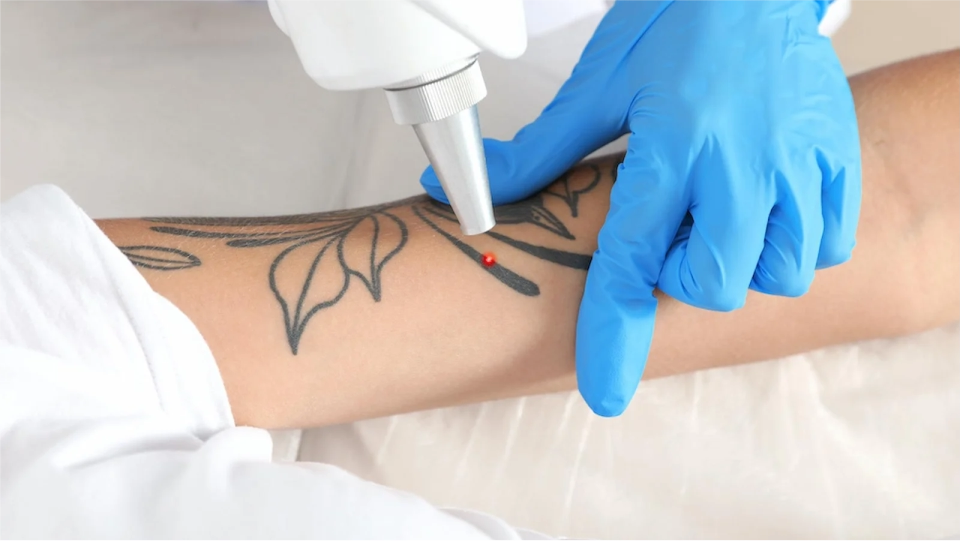 Eliminación de tatuajes