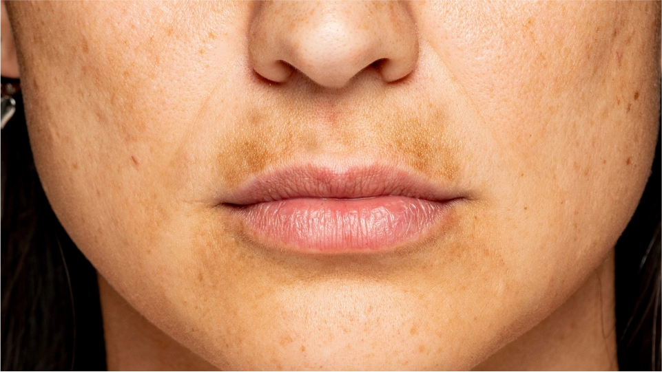 Melasma