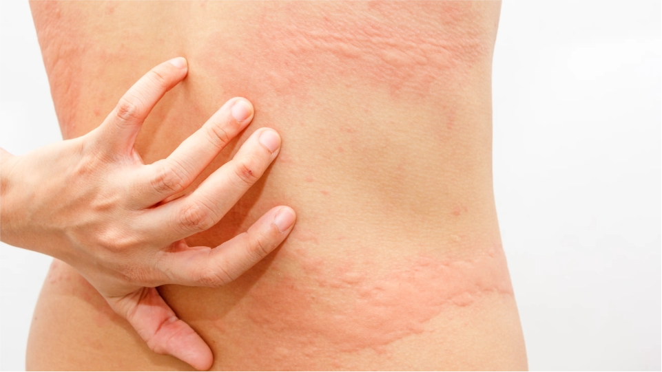 Psoriasis