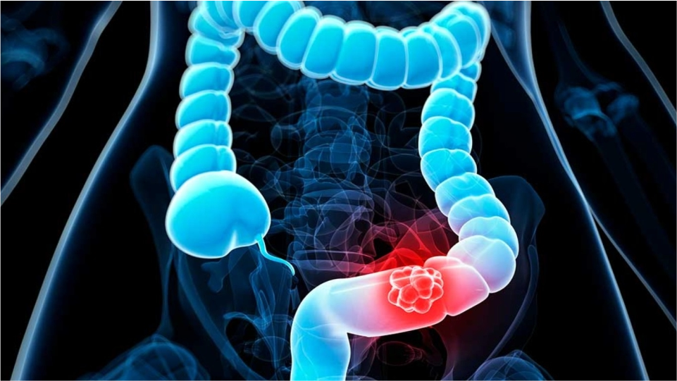 Cáncer de colon