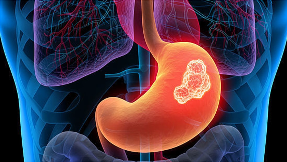 Cáncer de estómago