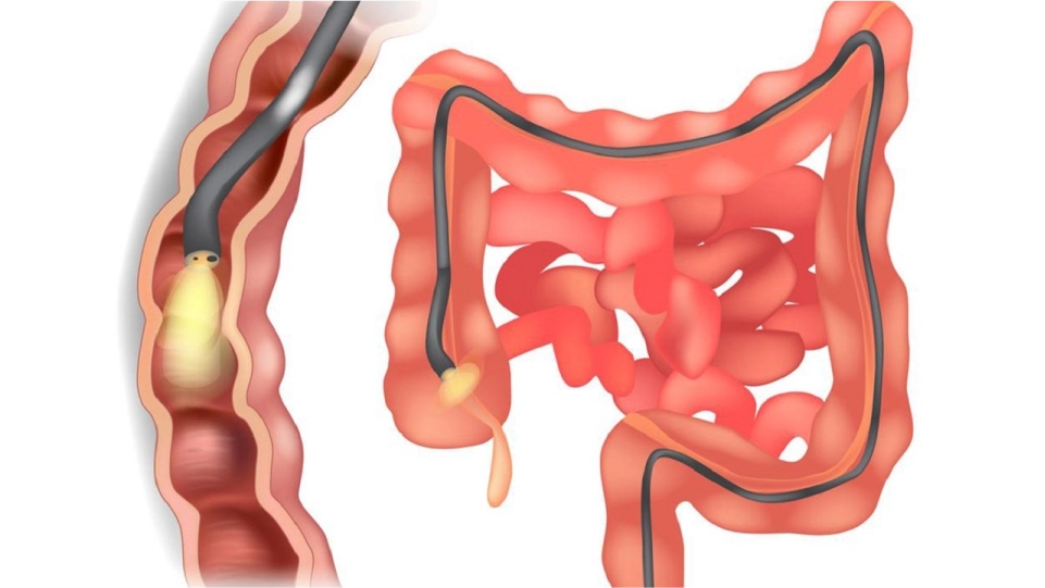 Colonoscopia completa