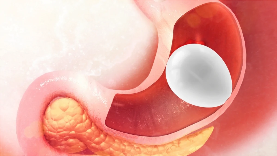 Dilatación de estenosis con balón hidróstatico