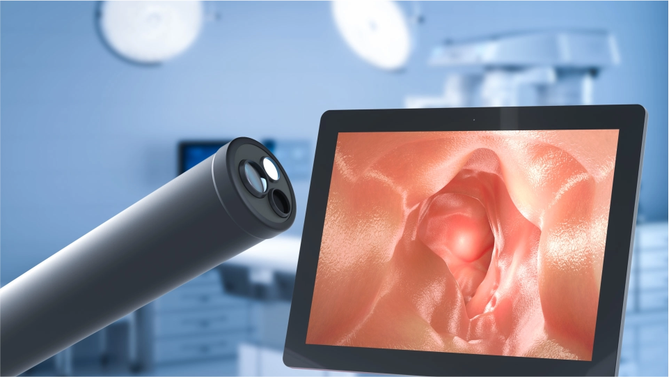 Extracción de cuerpo extraño por endoscopía