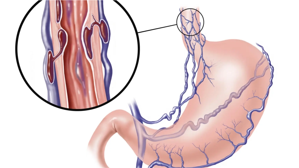 Ligadura de varices esofágica