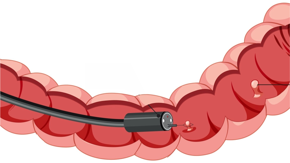 Mucosectomía en colon