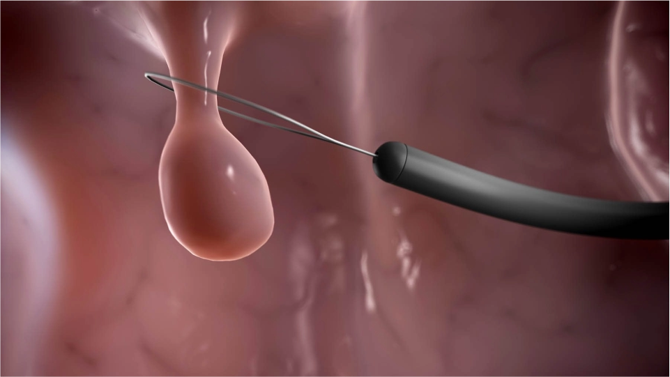 Mucosectomía en estómago