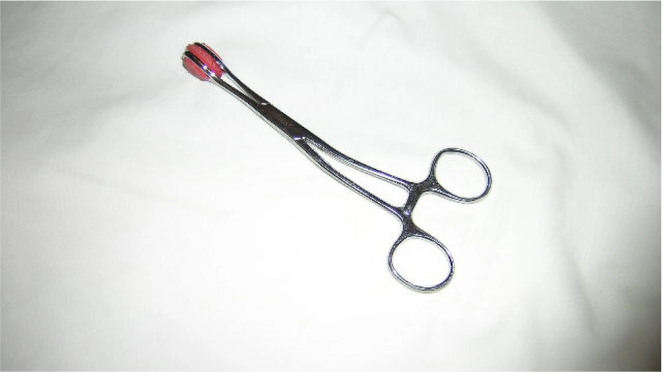 Polipeptomía con pinza de biopsia