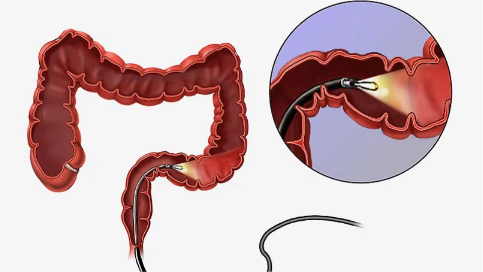 Sigmoidoscopia flexible