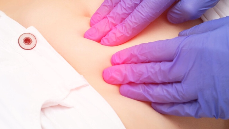 Drenaje y curación de hematoma vulvar