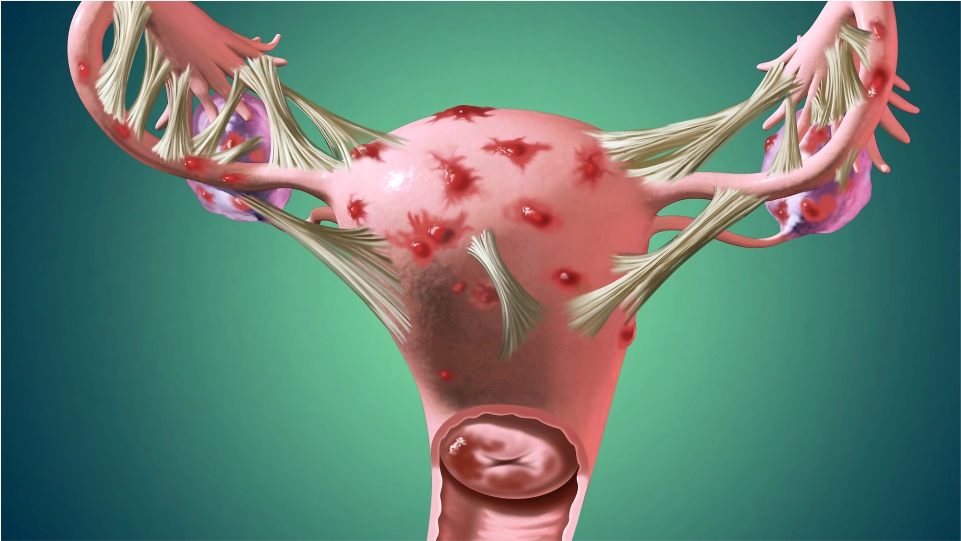 Endometriosis