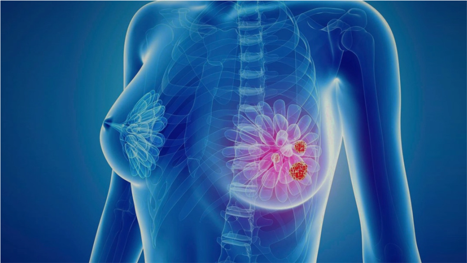 Exeresis de fibroadenoma de mama