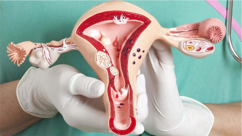 Exeresis de tumoración vulvar