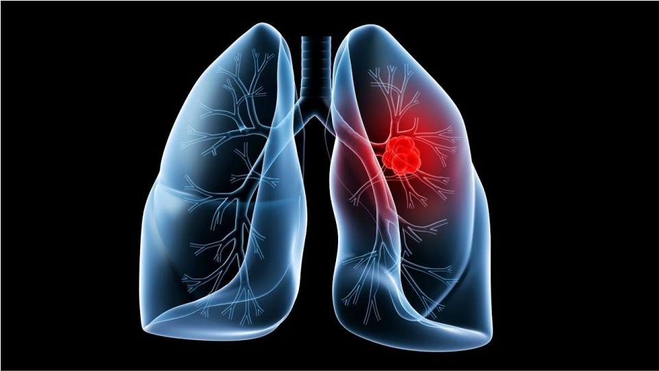 Enfermedad pulmonar obstructiva crónica EPOC