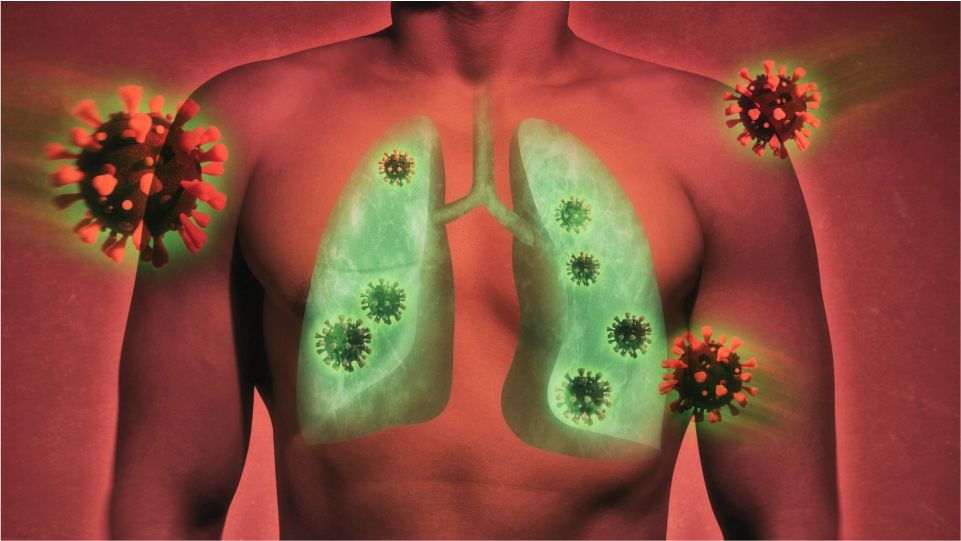 Patología pulmonar infecciosa y sus complicaciones