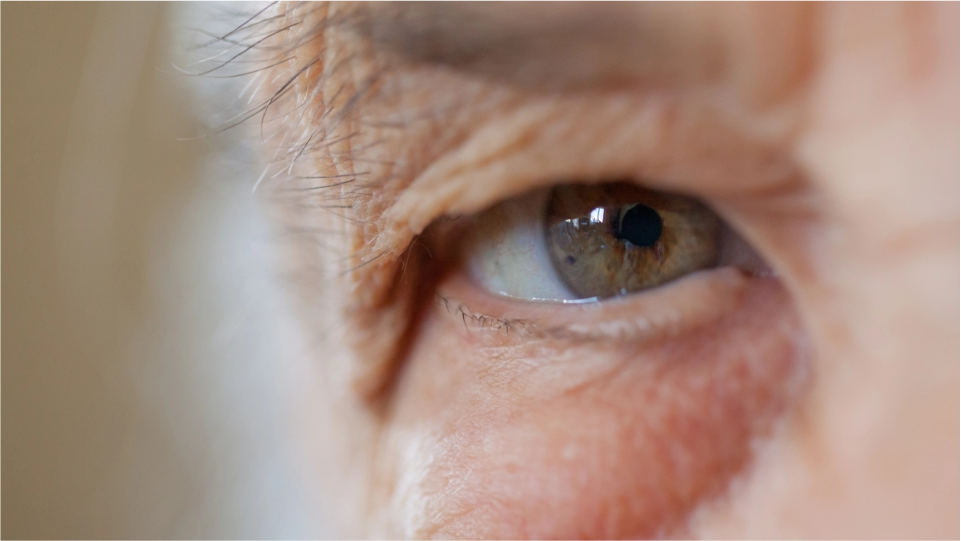 Glaucoma