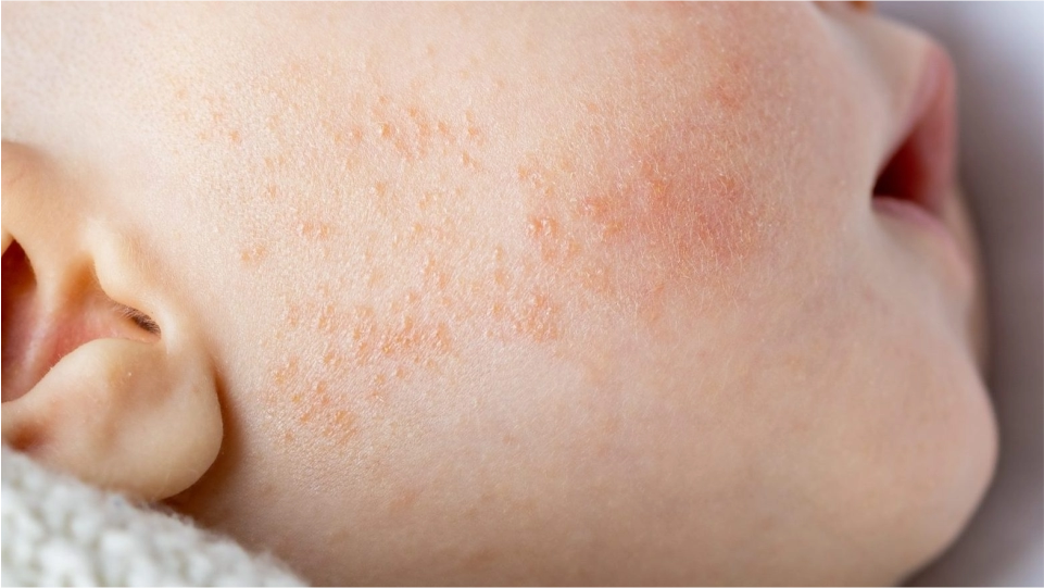 Dermatitis atópica eccema
