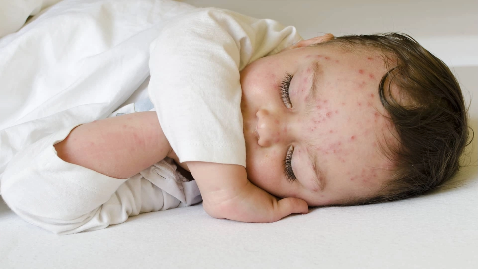 Infecciones comunes. Varicela, paperas y sarampión