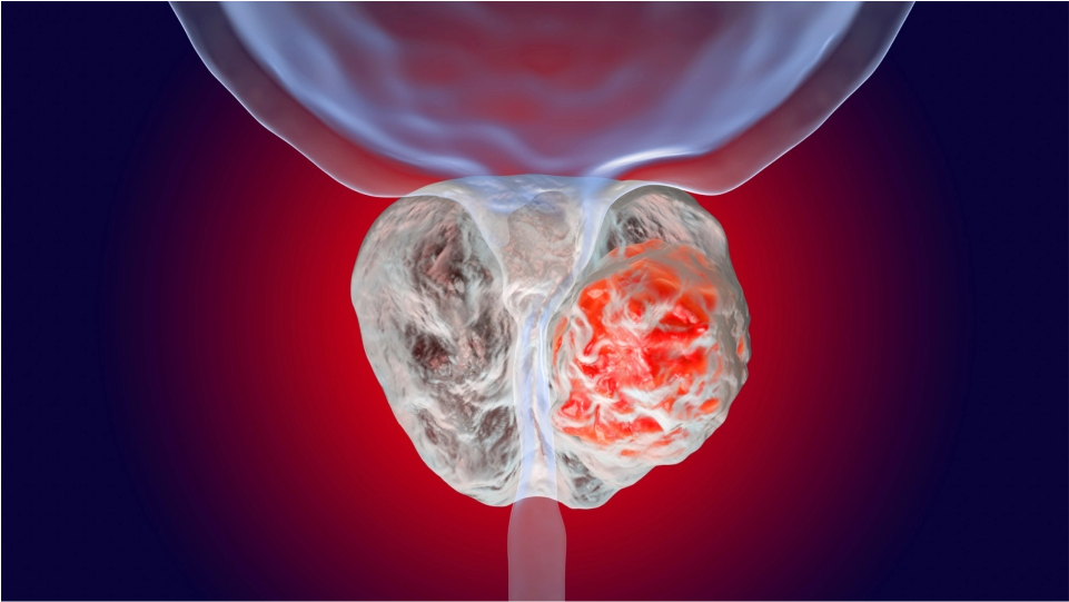 Cáncer de prostata